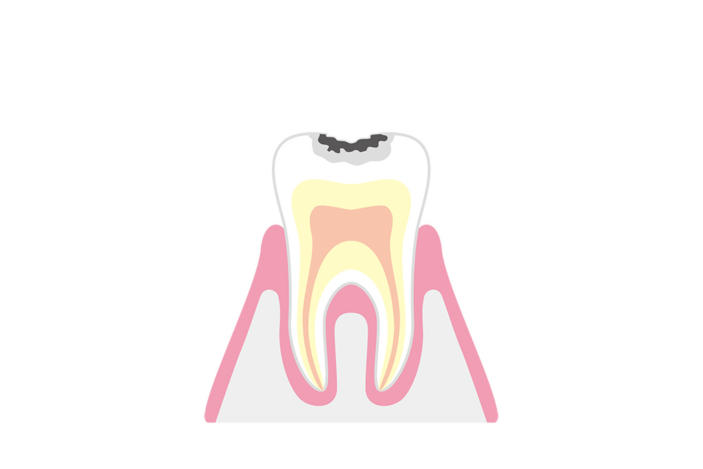 C1：エナメル質内のむし歯