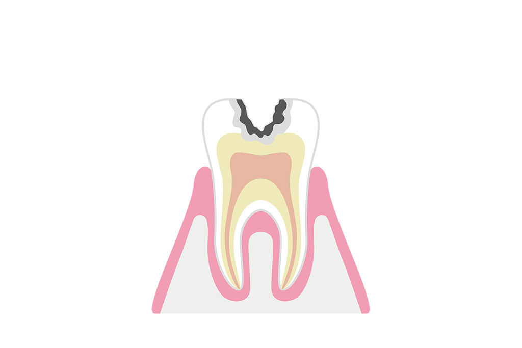 C2：象牙質に達したむし歯