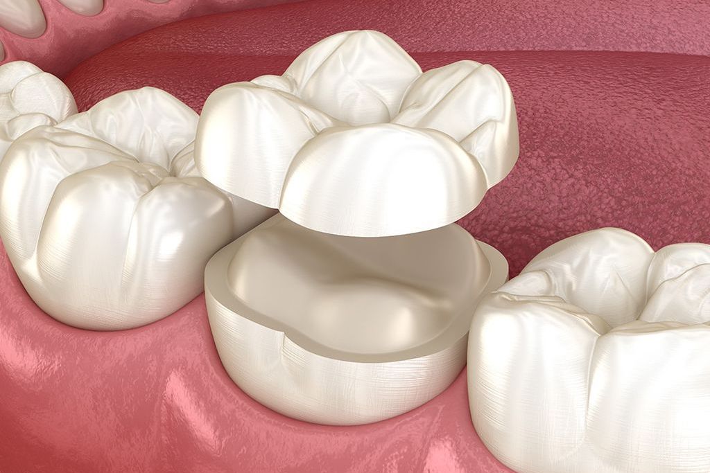 自由診療で用いるセラミック