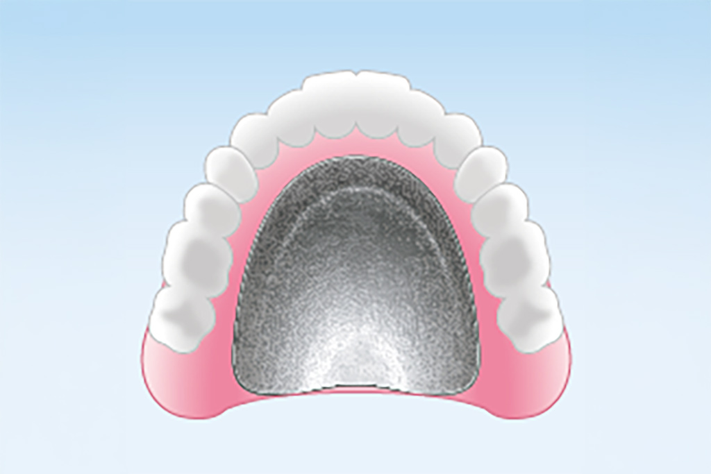 金属床義歯（部分入れ歯〜総入れ歯）
