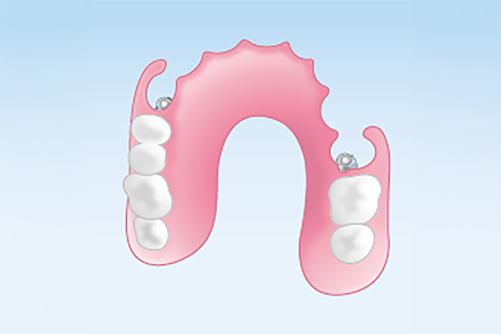 ノンクラスプデンチャー（部分入れ歯）