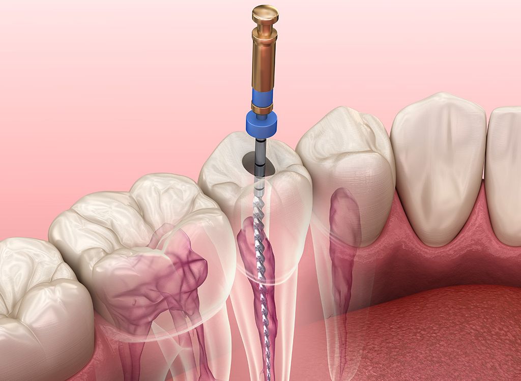 根管治療とは？