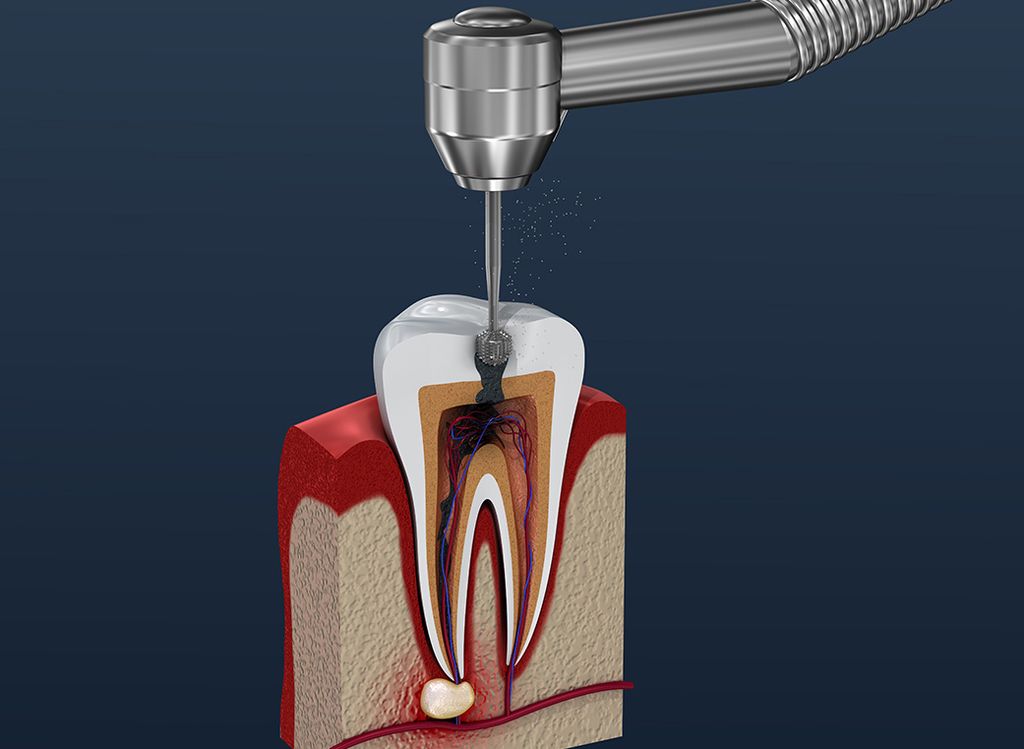 感染部位の除去