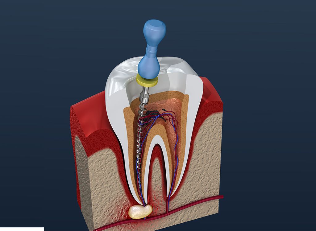 根管内の洗浄・消毒