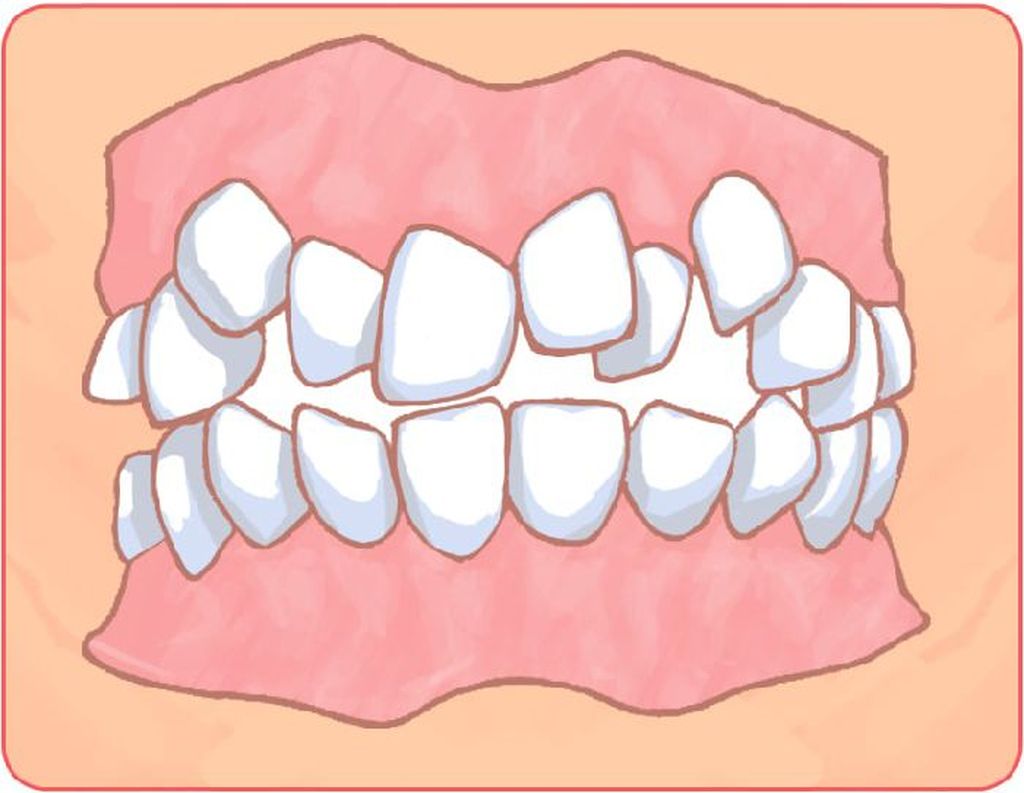叢生（乱ぐい歯）