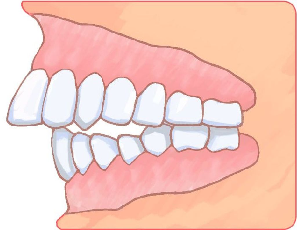 上顎前突（出っ歯）