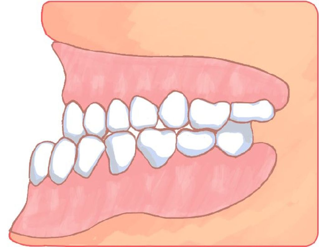 下顎前突（受け口）