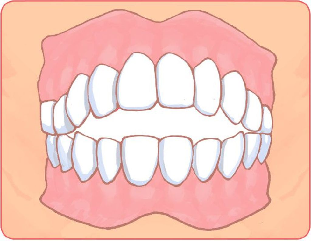 開咬（オープンバイト）
