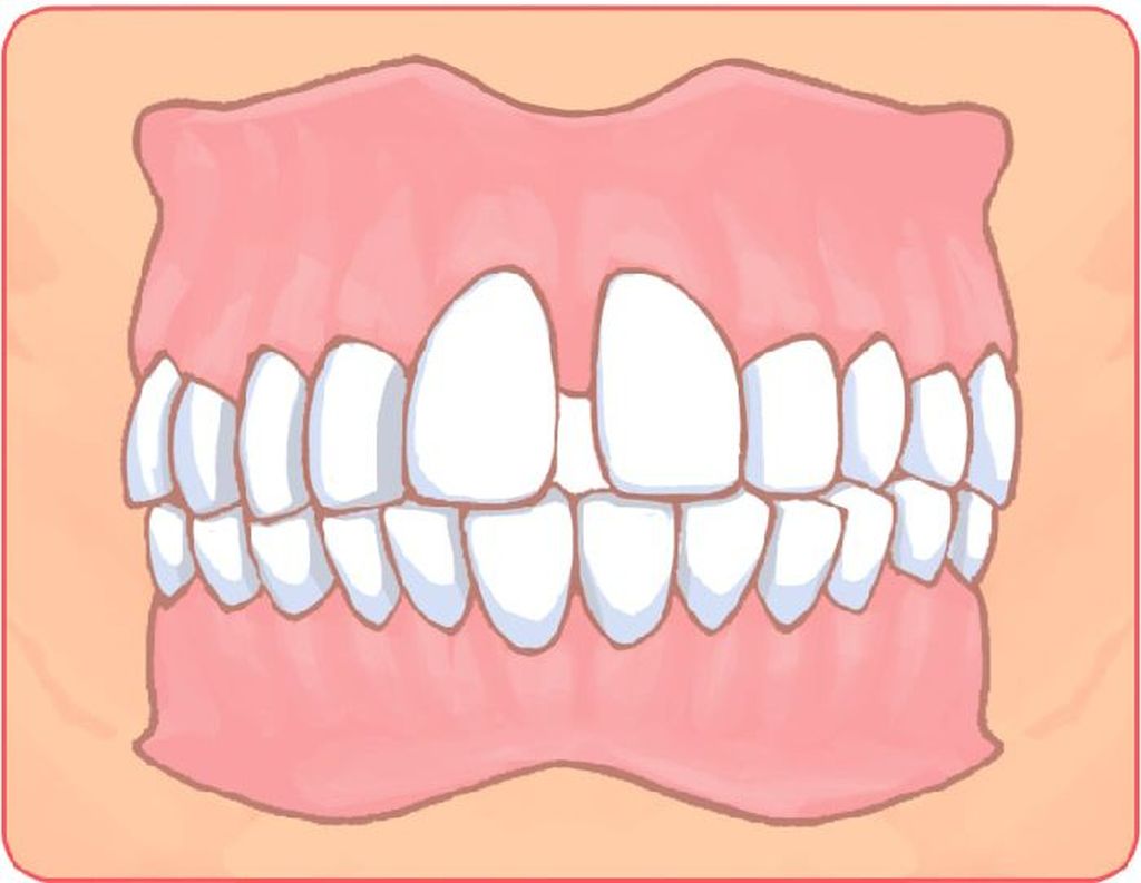空隙歯列（すきっ歯）