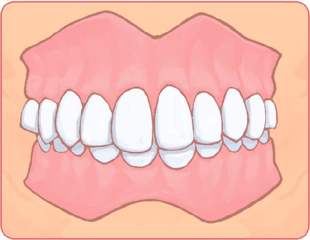 過蓋咬合（ディープバイト）